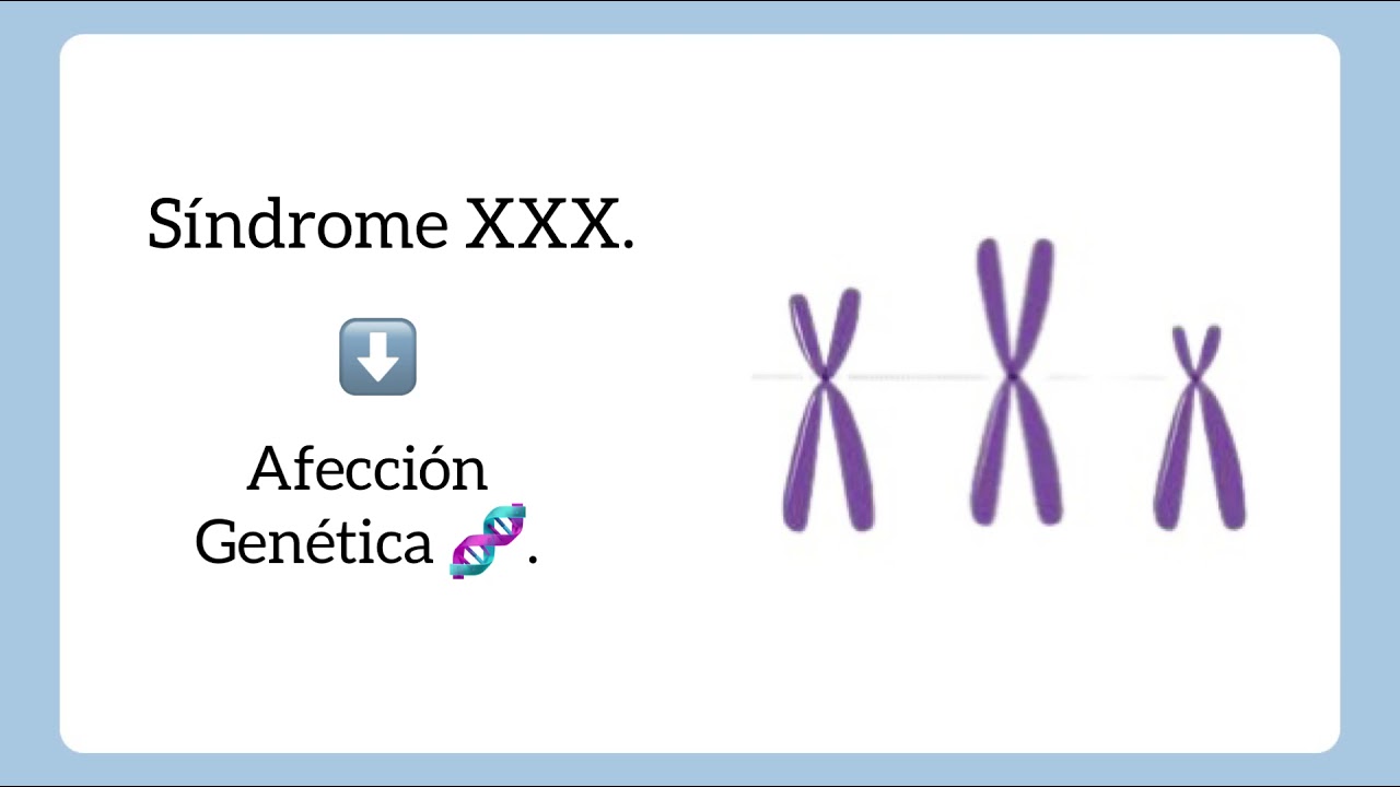 caracteristicas del sindrome de triple x