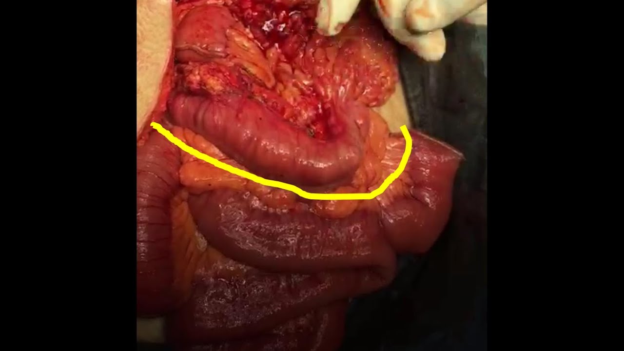 diferencia entre intestino delgado y grueso