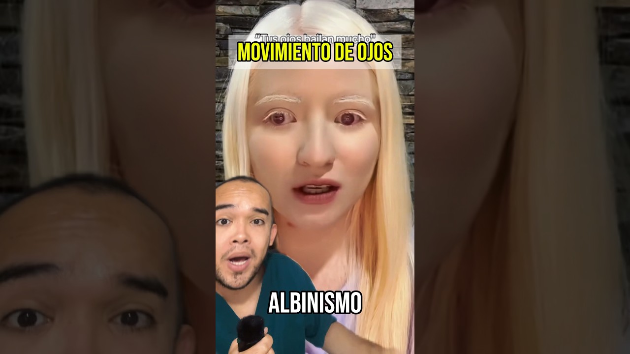 porque a los albinos se les mueven los ojos